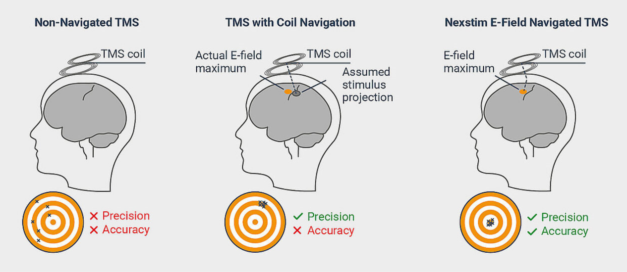 Comparison of no navigation, line-navigation and E-field navigated TMS