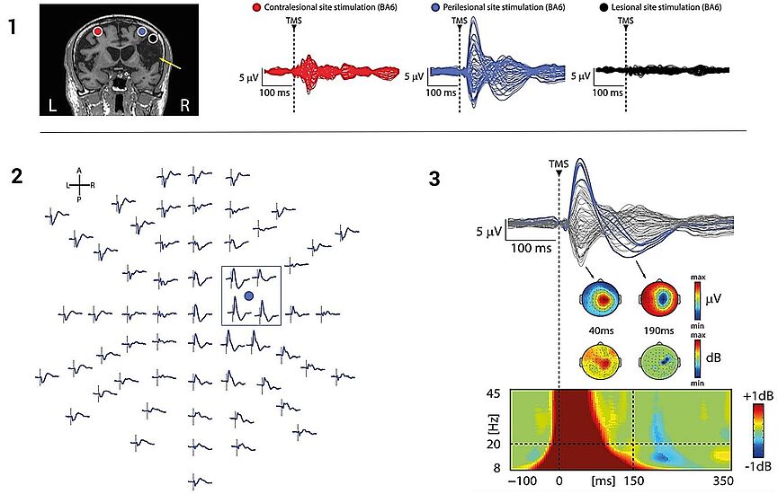 TMS reveals local, sleep-like slow waves associated with cortical OFF-periods over the affected hemisphere during TMS-EEG