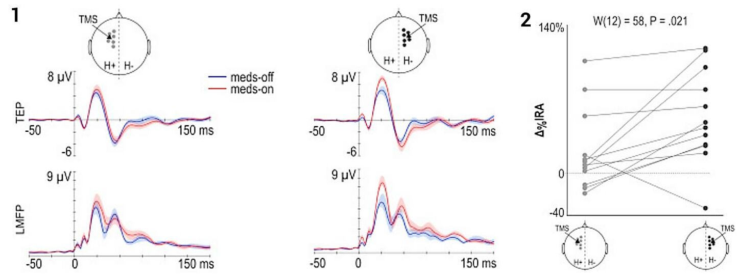 Cortical excitability changes in the supplementary motor area in Parkinson patients with and without medication during TMS-EEG as shown in Casarotto et al. 2019 (Image courtesy of Silvia Casarotto / Milan University).