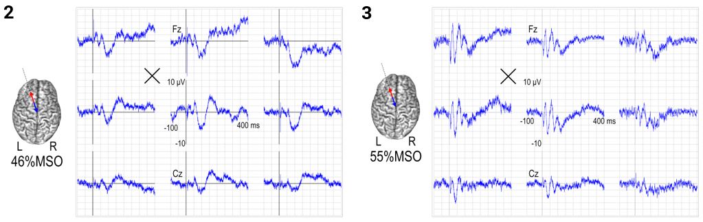 Auditory- and TMS-evoked potential (Image courtesy of Silvia Casarotto / Milan University). 