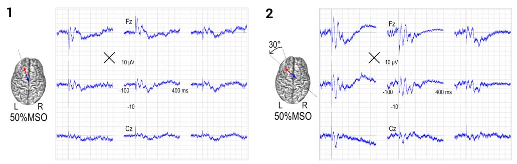 TMS-EEG potentials at different coil orientations (Image courtesy of Silvia Casarotto / Milan University). 